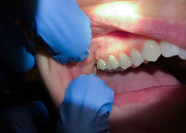 Best Emergency Dental Care for Broken or Chipped Teeth in Vonore, TN